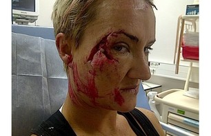 Keala Kennelly After Being Mauled at Teahupoo