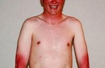 15 Ridiculous Sun Burn Photos