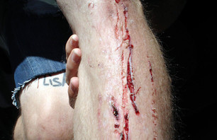 Tom Dugan shredded shin