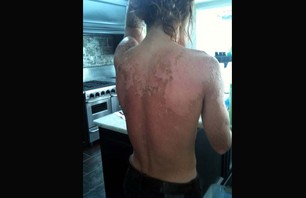 Shaun White Gets Real Red - Sunburned That is!