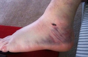 That snake got Betley's ankle real good... 